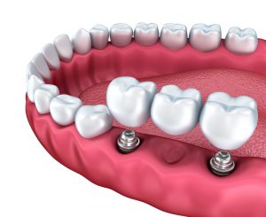 http://www.dreamstime.com/stock-image-close-up-view-lower-teeth-dental-implants-isolated-white-image53759391