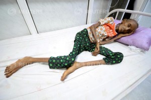 A Picture and its Story: Recovering from severe malnutrition in Yemen
